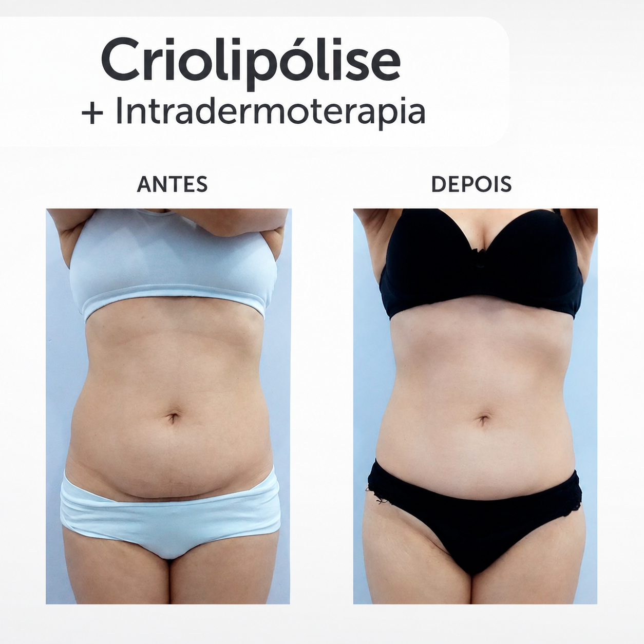 Antes e depois do protocolo de criolipólise e intradermoterapia